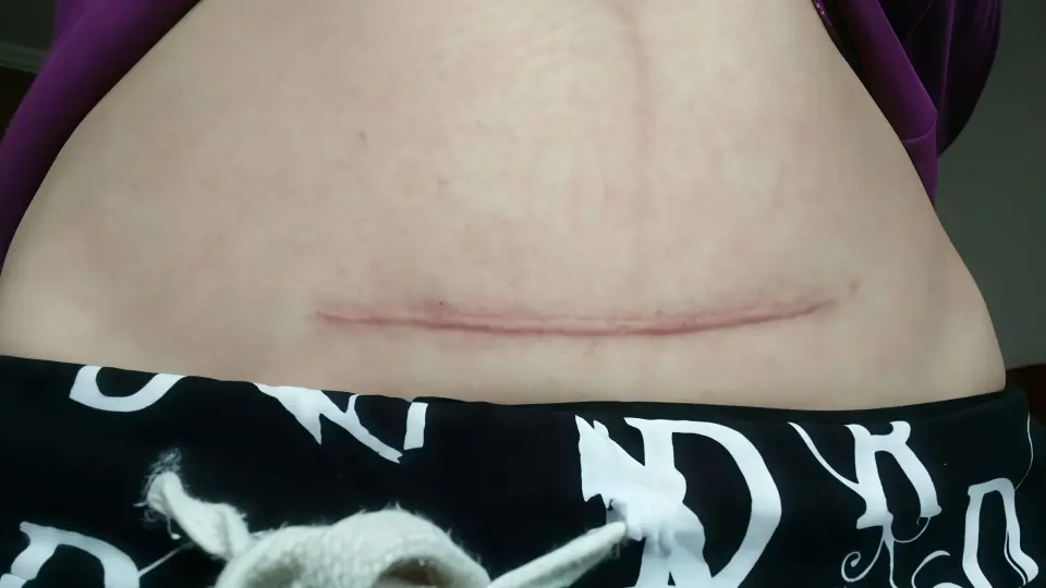 Cesarean section scar Cesarean section scar