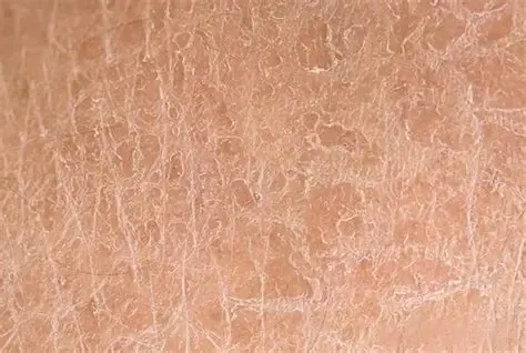 dry skin dry skin